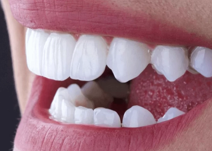 Chất lượng răng sứ Zirconia