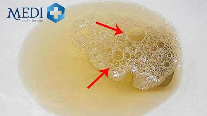 Lực tiểu mạnh có thể gây ra nước tiểu có bọt