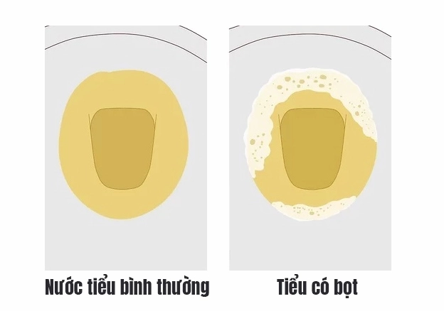 nuoc-tieu-co-bot-khi-nao-binh-thuong-khi-nao-ang-lo_198