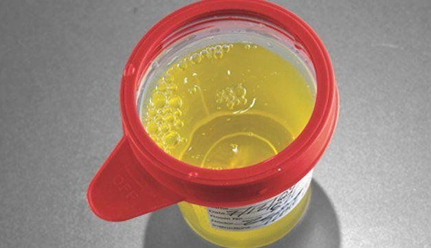 Thận bị tổn thương, nguyên nhân gây nước tiểu có bọt